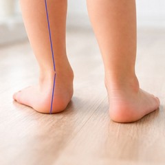 Piede piatto nei bambini