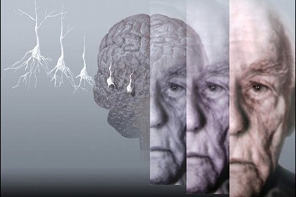 Seminario sull'Alzheimer