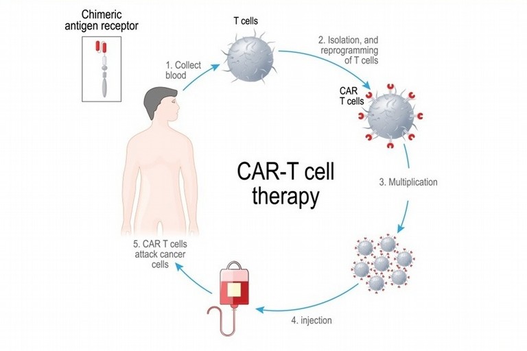 Cancro: le terapie geniche CAR-T