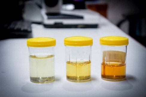 Il colore dell'urina può rivelare molto sulla tua salute